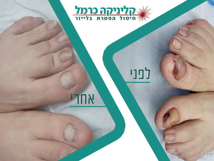 קליניקה כרמל – המומחים בטיפול בפטרייה בציפורן בלייזר