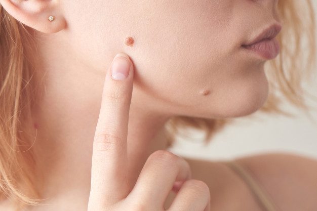 צילום: FREEPIK הסרת נגעי עור וסרחי עור למראה עור אחיד וחלק במרכזים המובילים