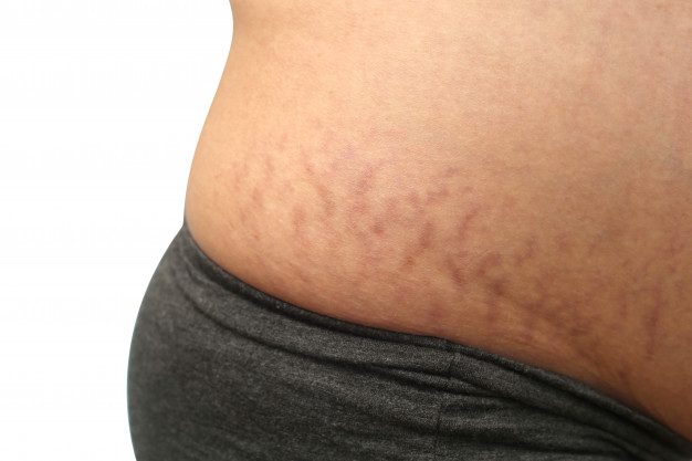 צילום: freepik השיטות המתקדמות ביותר להעלמת סימני מתיחה במרכזיים המובילים